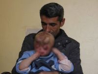 Minik Serkan yüz nakli bekliyor
