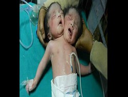 Hindistan'da çift başlı bebek,,,