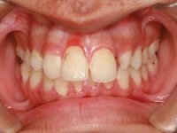 Uzmanlardan enfeksiyonlu diş hakkında önemli uyarı